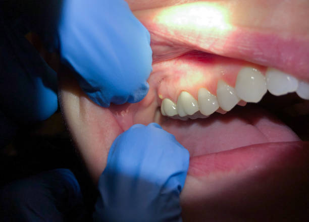 Best Dentist for Tooth Abscess  in Towson, MD